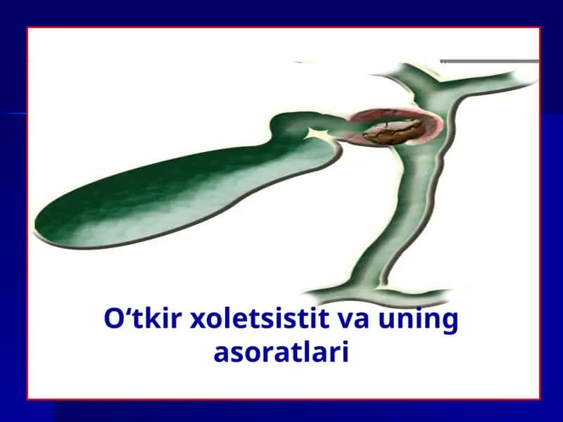 O‘tkir xoletsistit va uning asoratlari