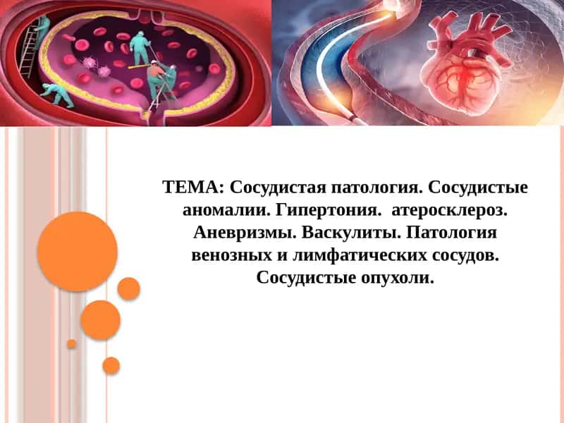 Сосудистая патология. Сосудистые аномалии. Гипертония.  атеросклероз. Аневризмы. Васкулиты. Патология венозных и лимфатических сосудов. Сосудистые опухоли.