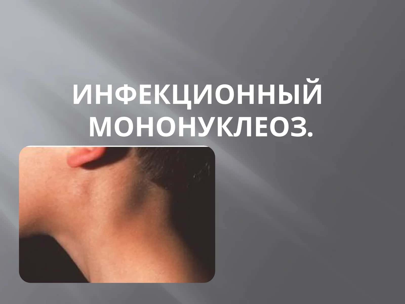 Инфекционный мононуклеоз
