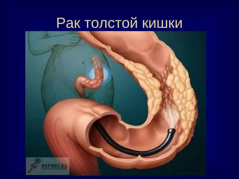Рак толстой кишки