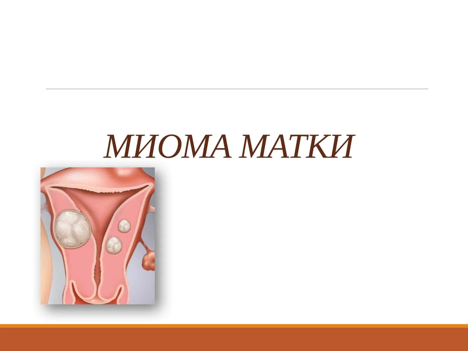 Миома матки