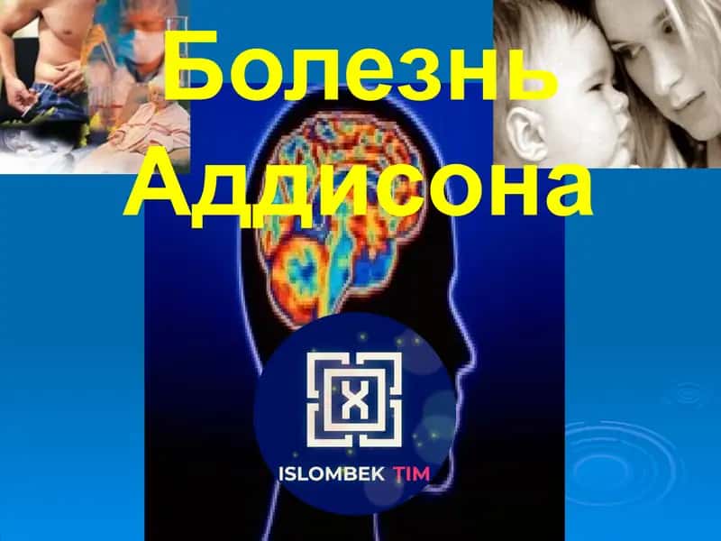 Болезнь Аддисона