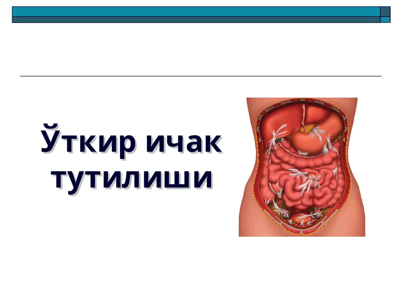 Ўткир ичак тутилиши