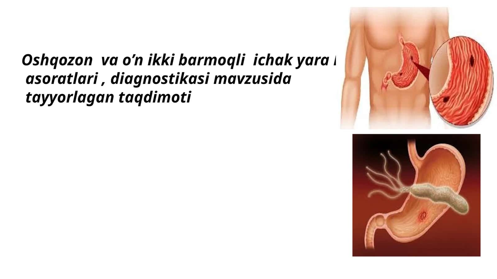 Oshqozon va o‘n ikki barmoqli ichak yara kasalligi asoratlari, diagnostikasi