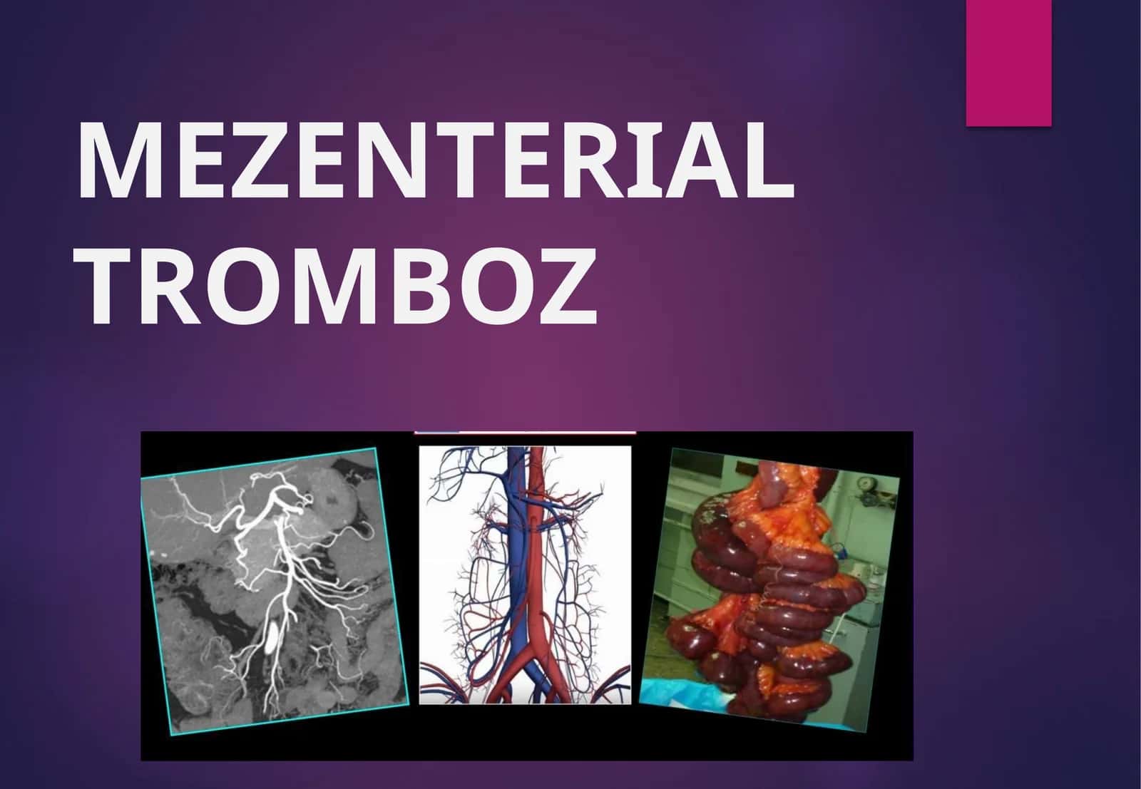 MEZENTERIAL TROMBOZ