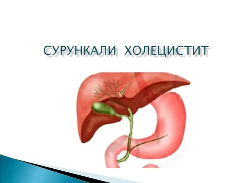 Холецистит