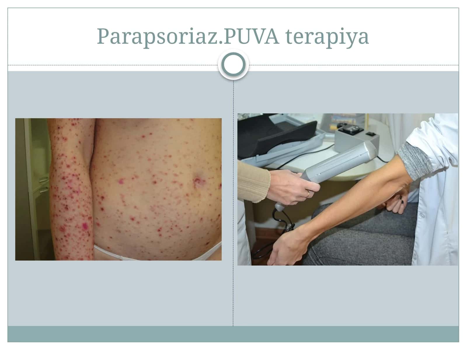 Parapsoriaz.PUVAterapiya