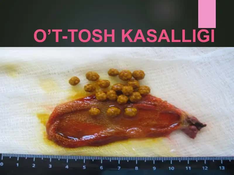 O't tosh kasalligi taqdimod pptx
