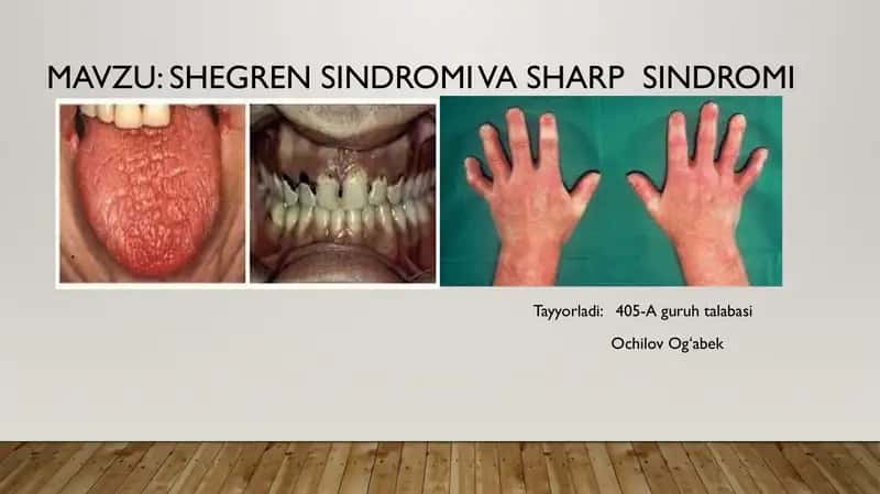 Shegren sindromi va Sharp sindromi