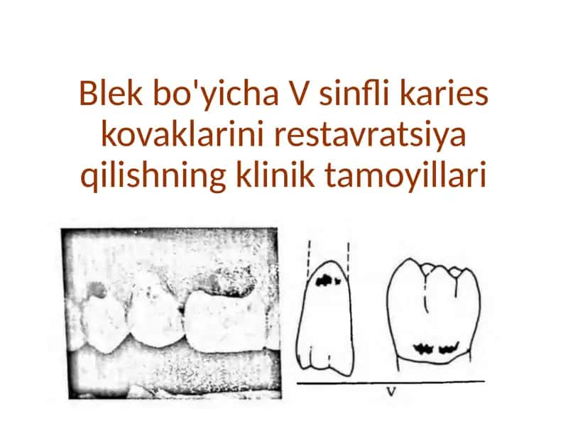 Blek 5-sinf. Karies kovaklarini restavratsiya qilishning klinik tamoyillari