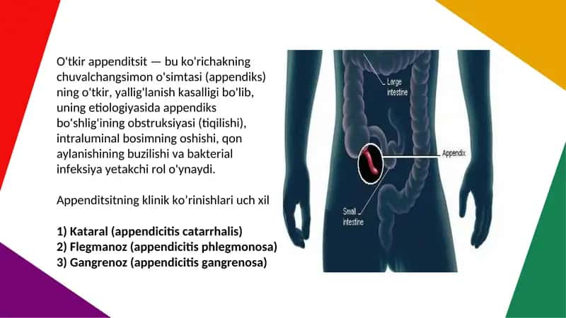 O'tkir appenditsit