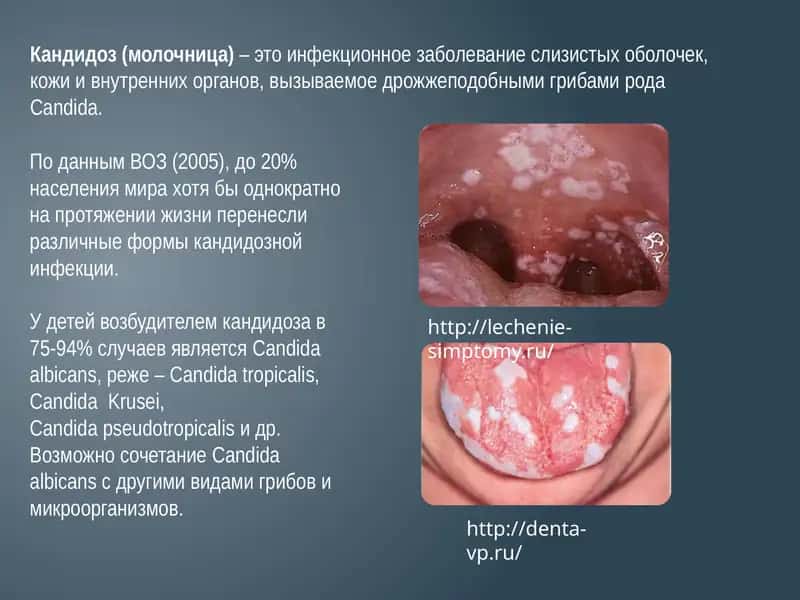 Кандидоз(молочница)