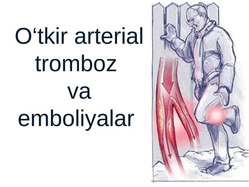 O‘tkir arterial tromboz va emboliyalar