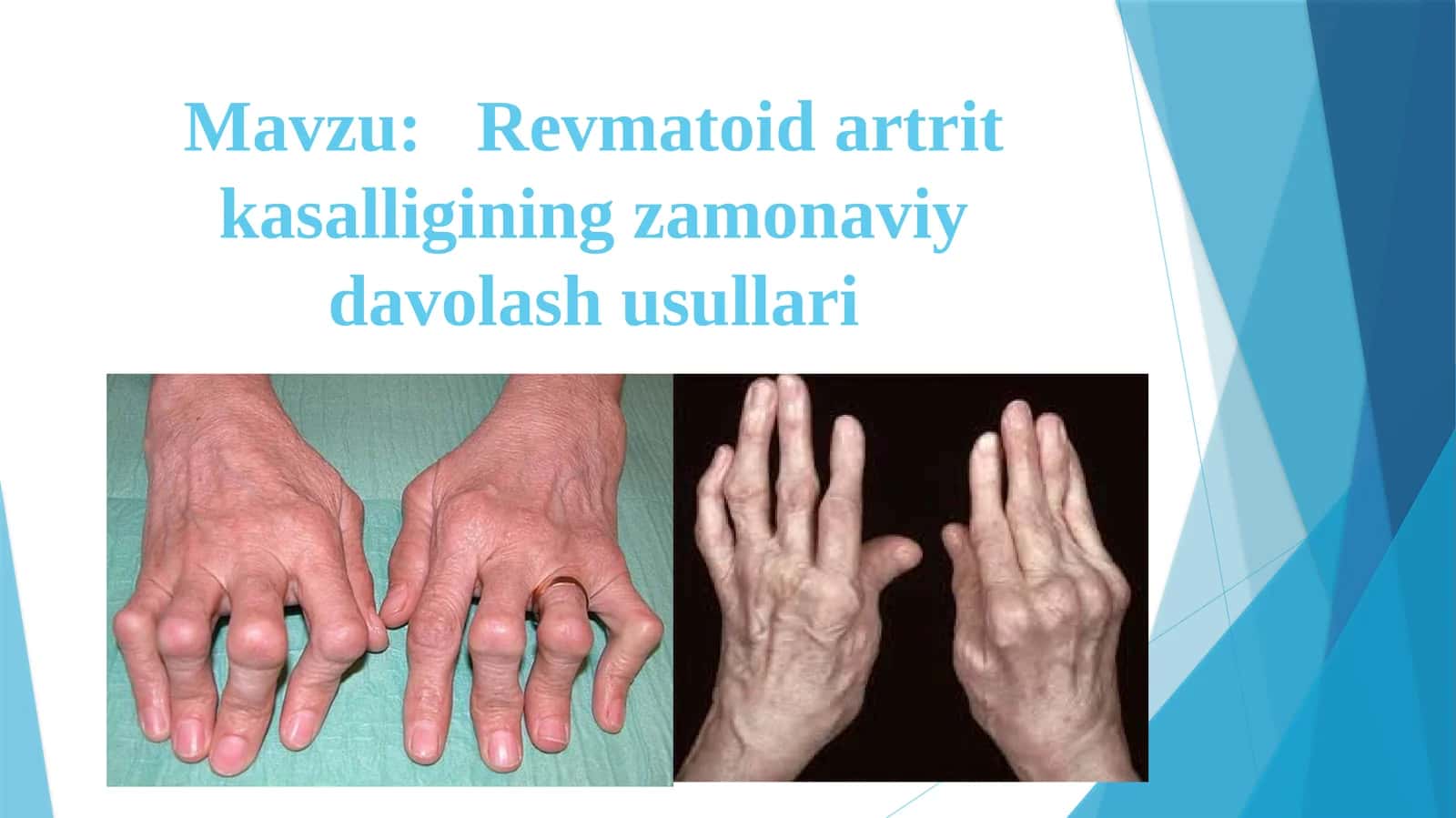 Revmatoidartritkasalligining zamonaviy davolash usullari