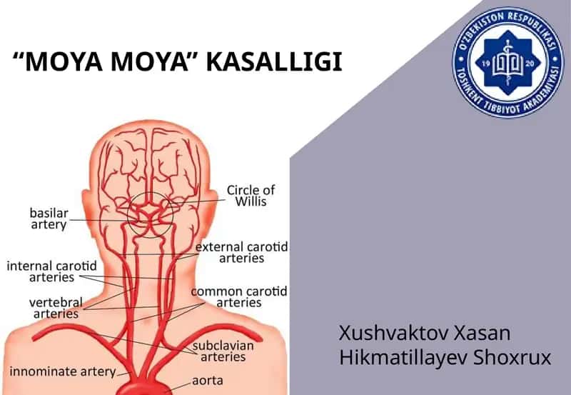 "Moyamoya"kasalligi