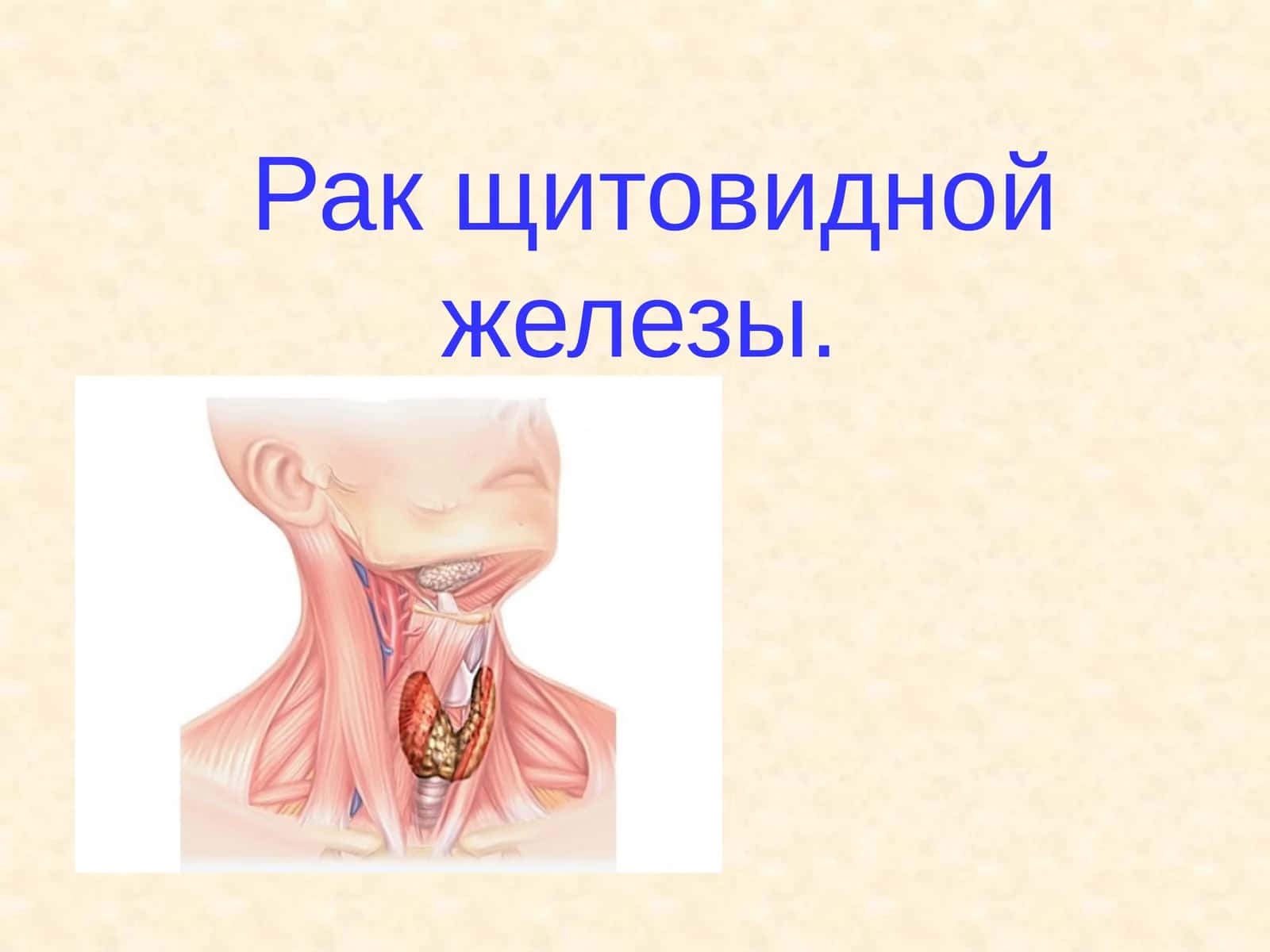 Рак щитовидной железы