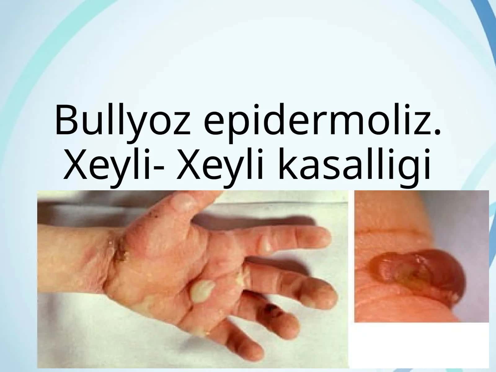 Bullyoz epidermoliz. Xeyli- Xeyli kasalligi