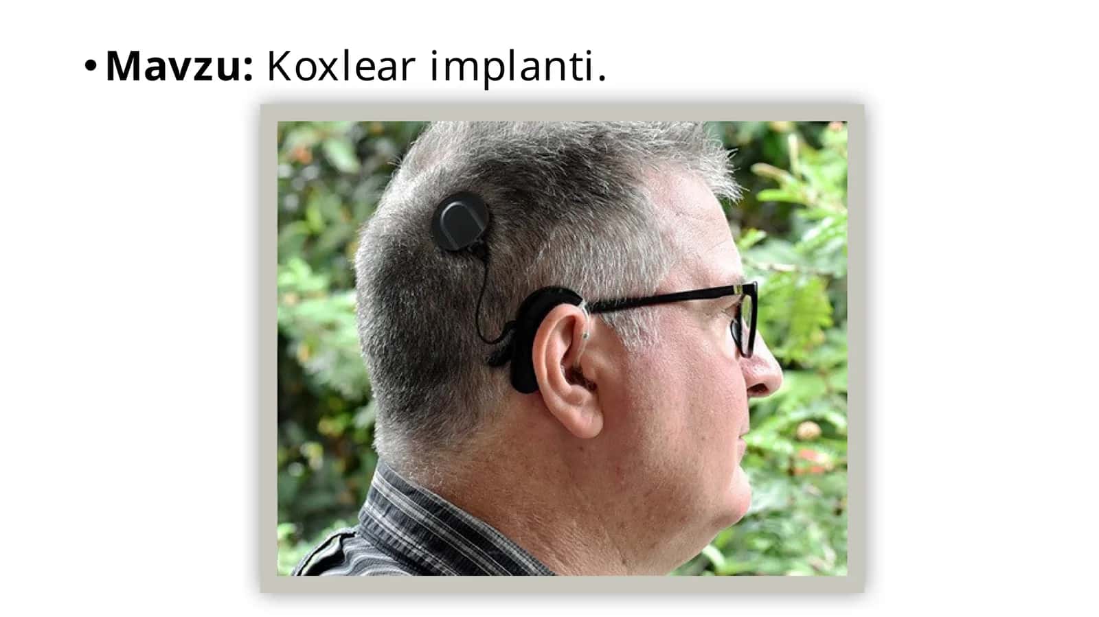 Koxlearimplanti