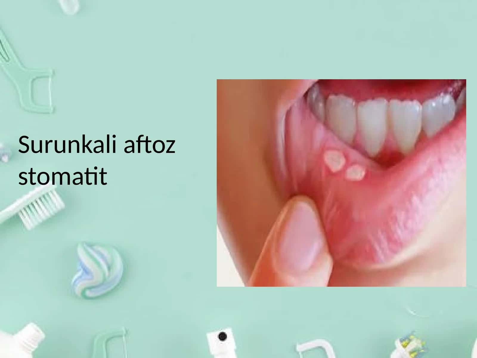 Surunkali aftoz stomatit