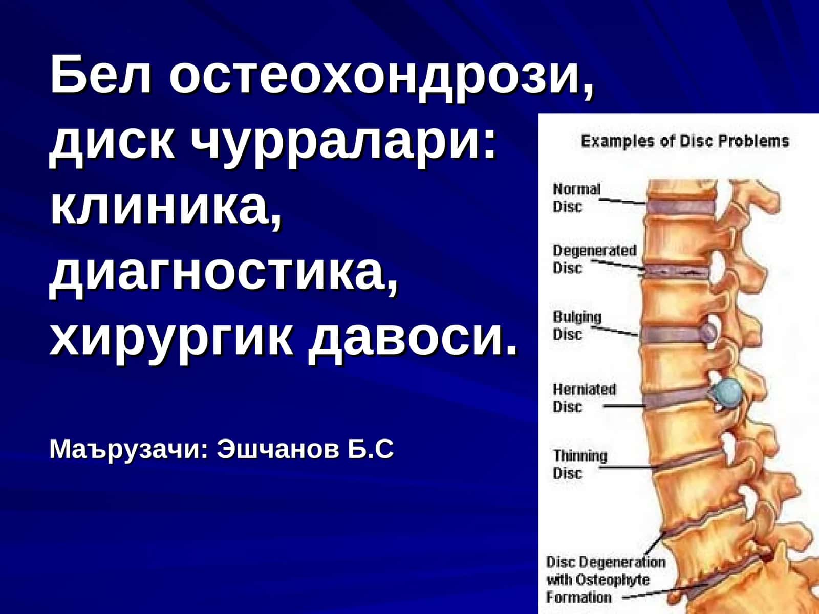 Бел остеохондрози
