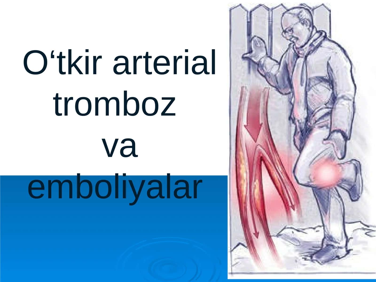 O‘tkir arterial tromboz va emboliyalar