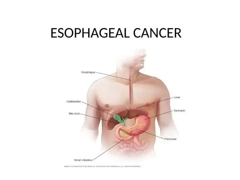 Esophageal Cancer