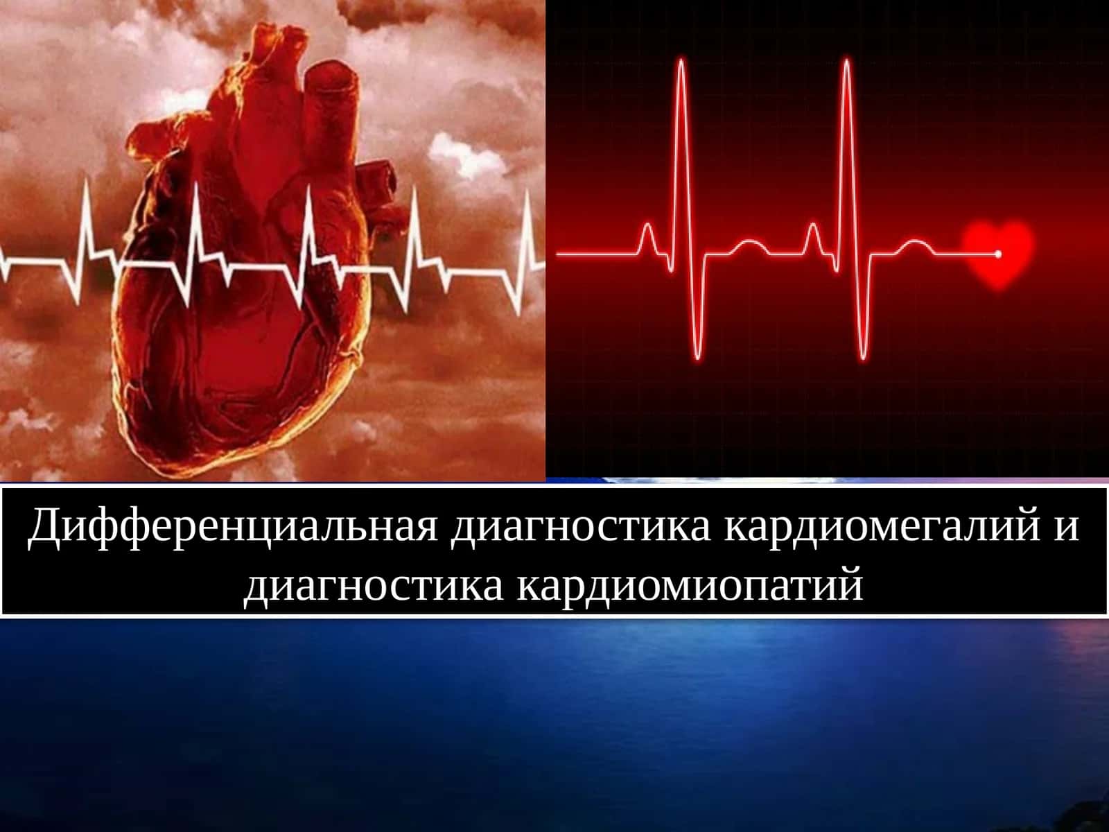 Дифференциальная диагностика кардиомегалий и диагностика кардиомиопатий