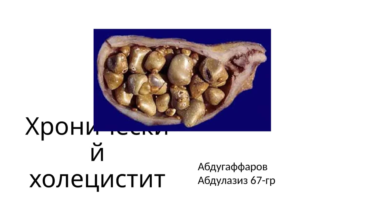 Хронический холецистит