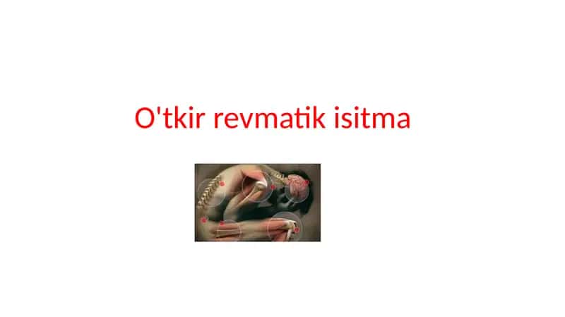O'tkir revmatik isitma