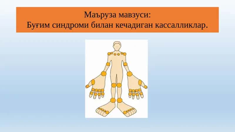 Буғим синдроми билан кечадиган кассалликлар