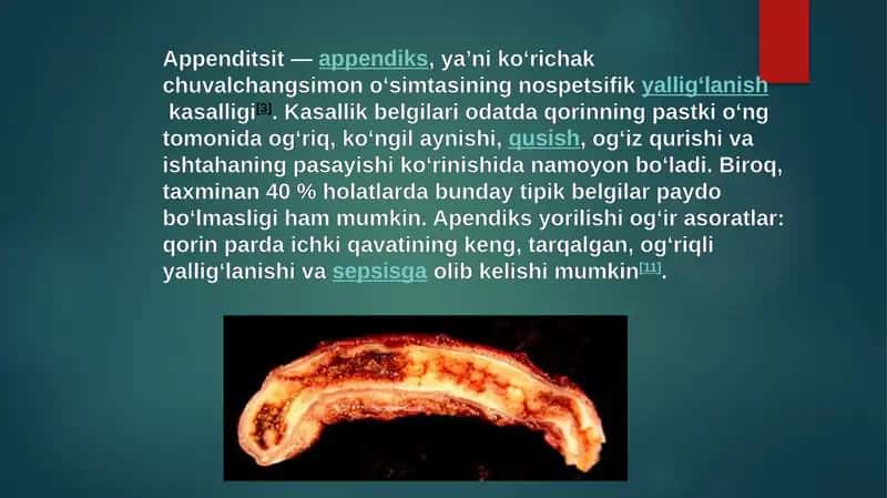 Appenditsit