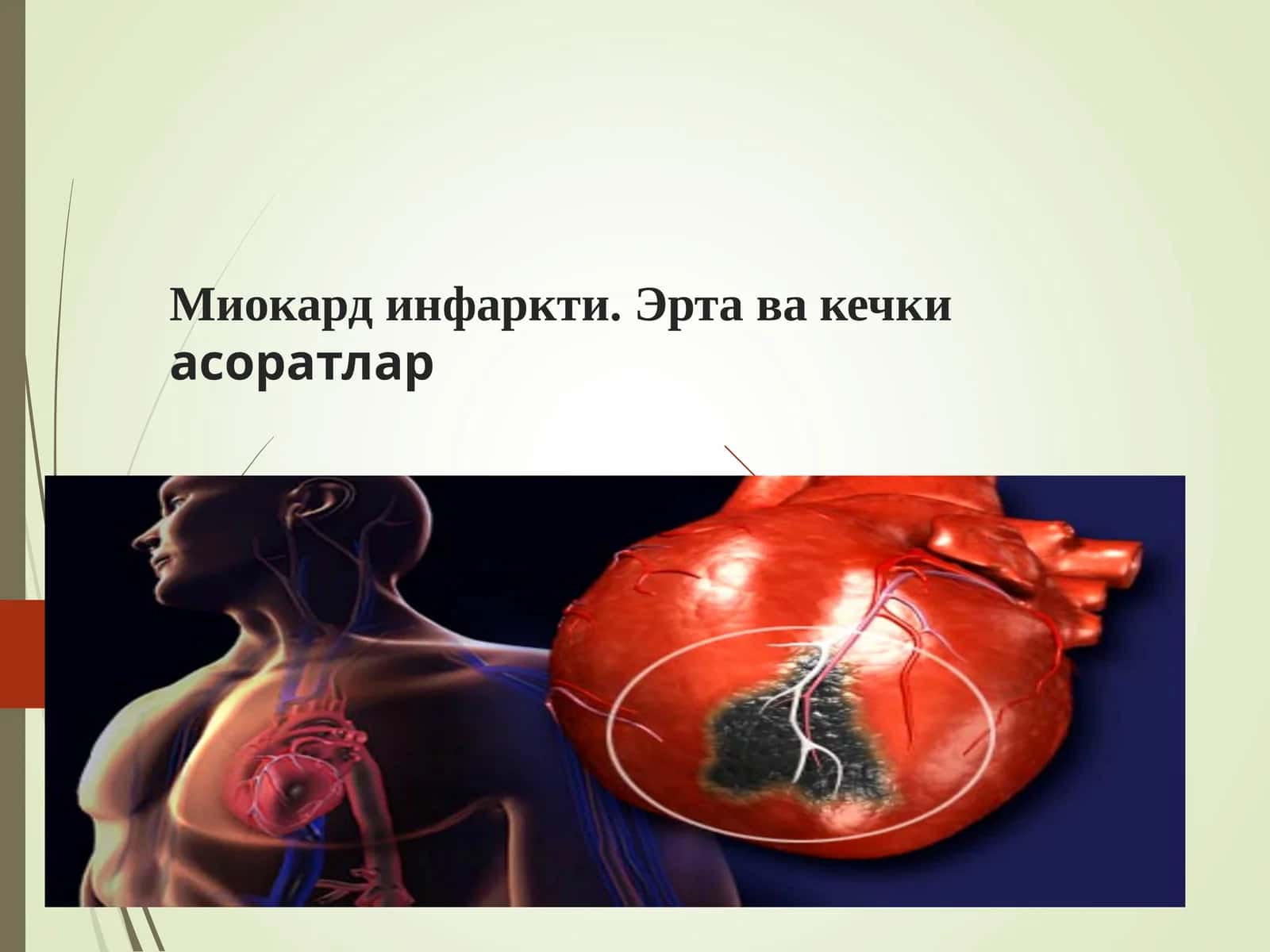 Миокард инфаркти. Эрта ва кечки асоратлар