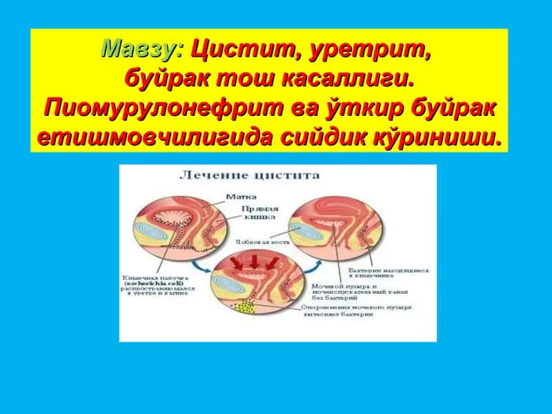 Цистит, уретрит,сурункали буйракетишмовчилиги