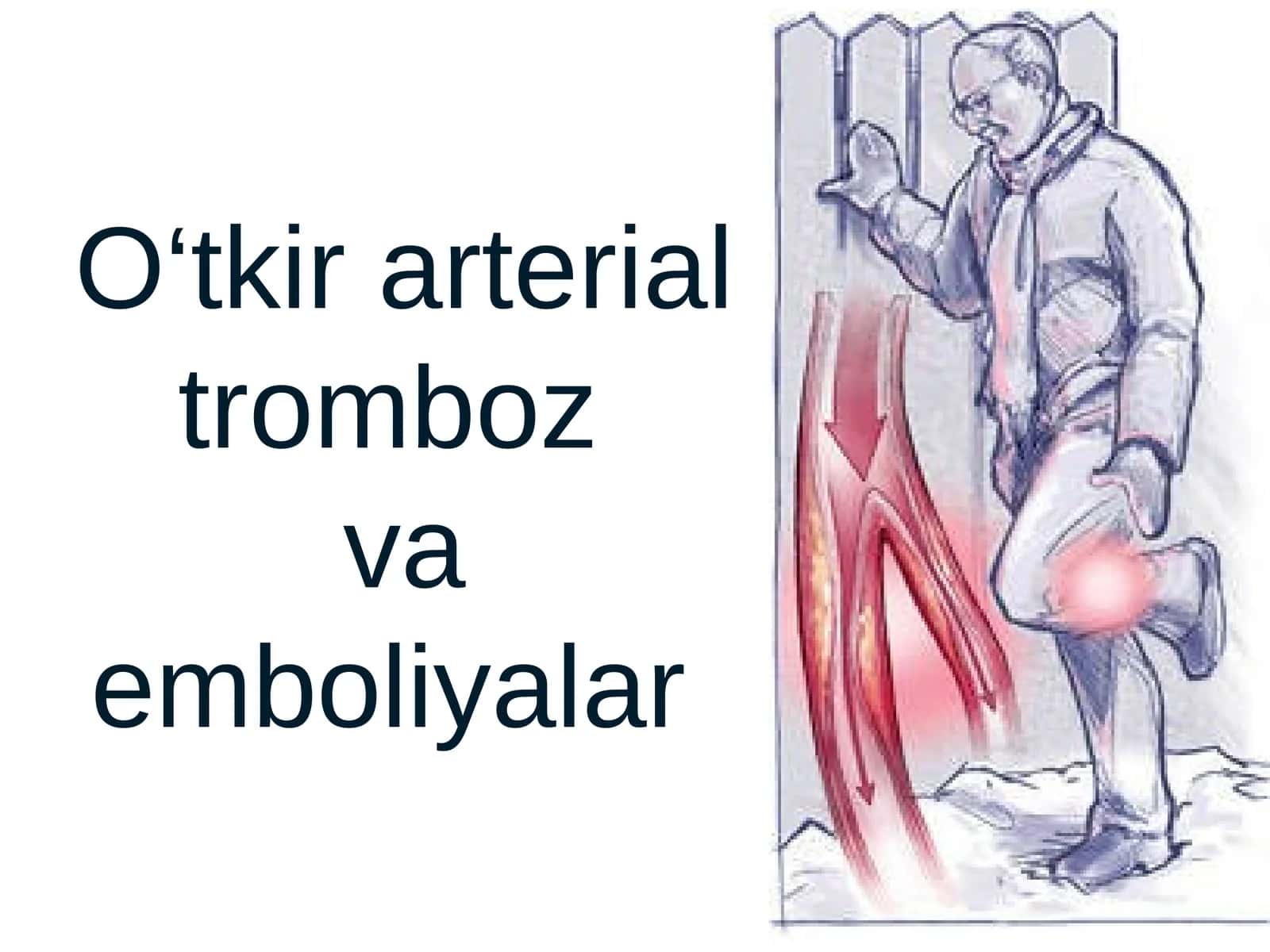O‘tkir arterial tromboz va emboliyalar