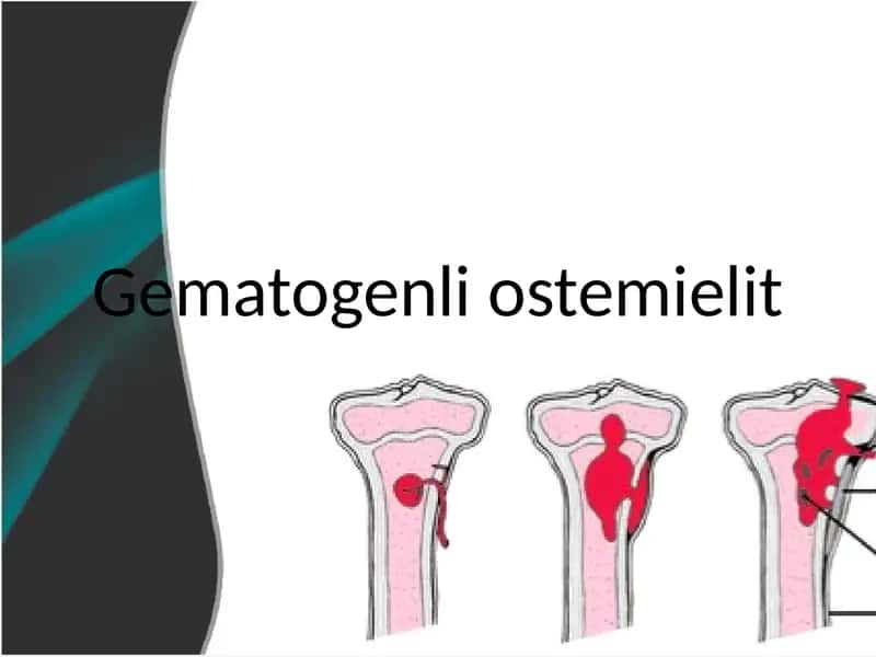 Gematogenli osteomiyelit