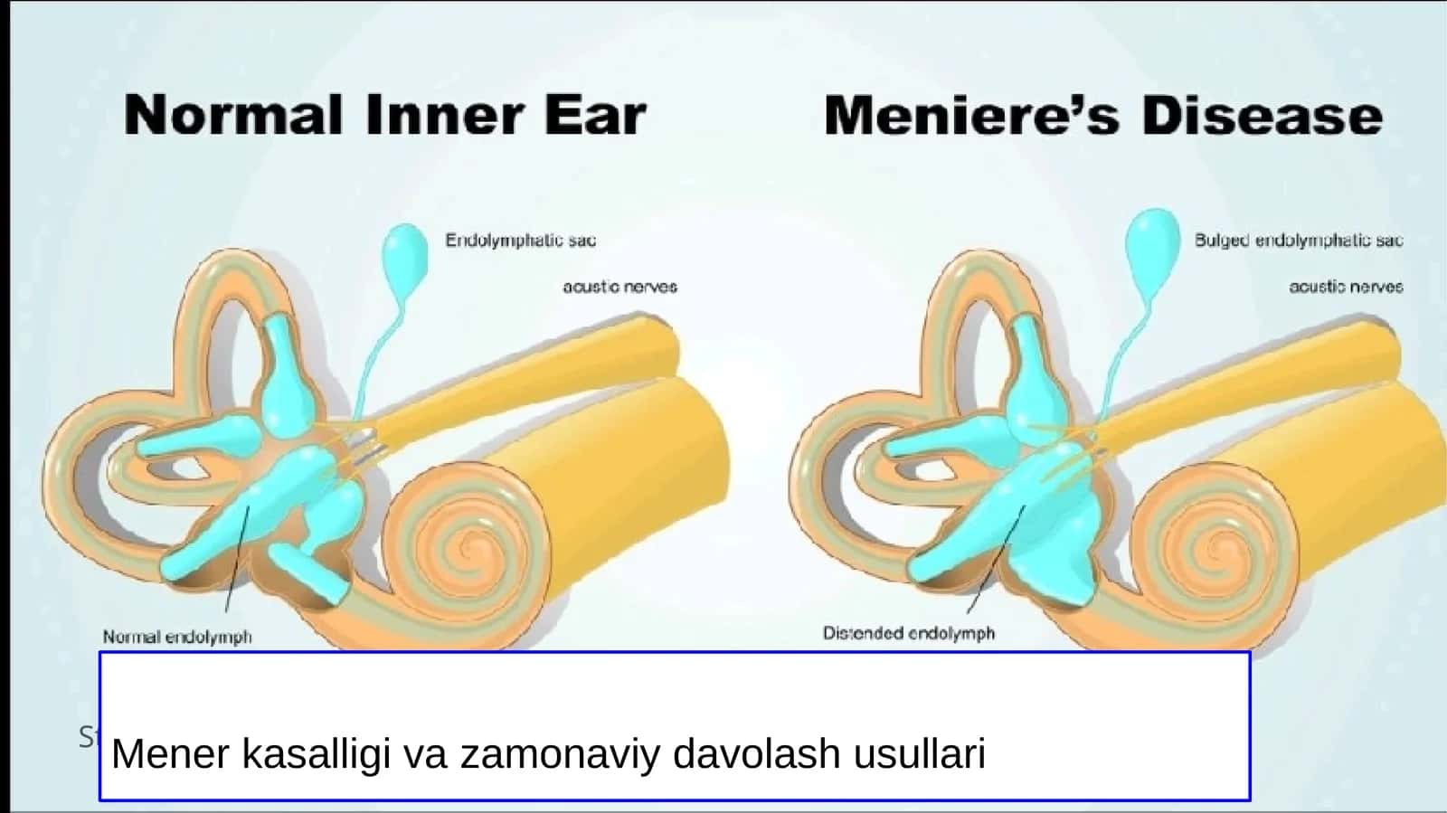 Mener kasalligi va zamonaviy davolash usullari