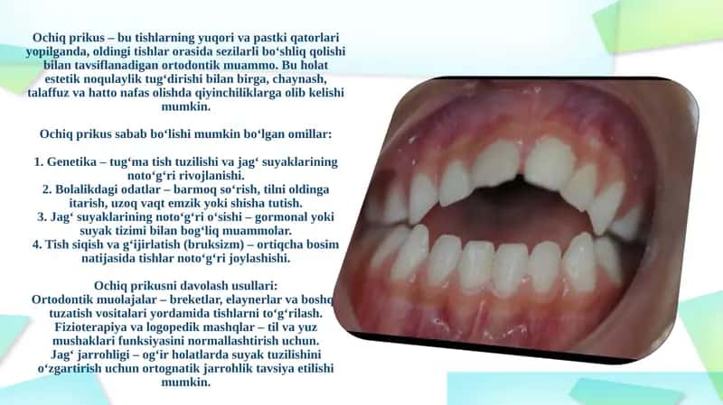 Ochiq prikus muammosi