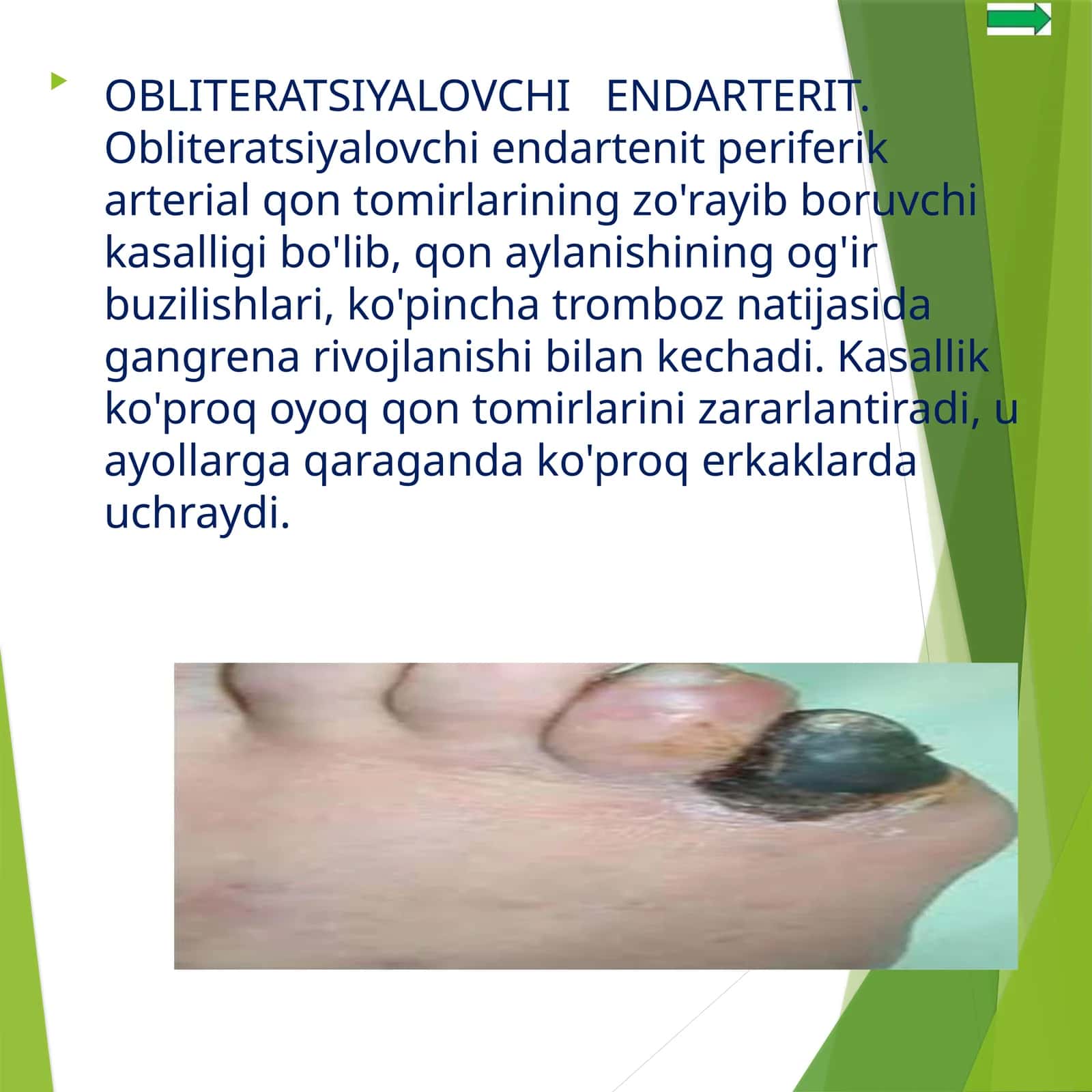 Obliteratsiyalovchi Endarterit