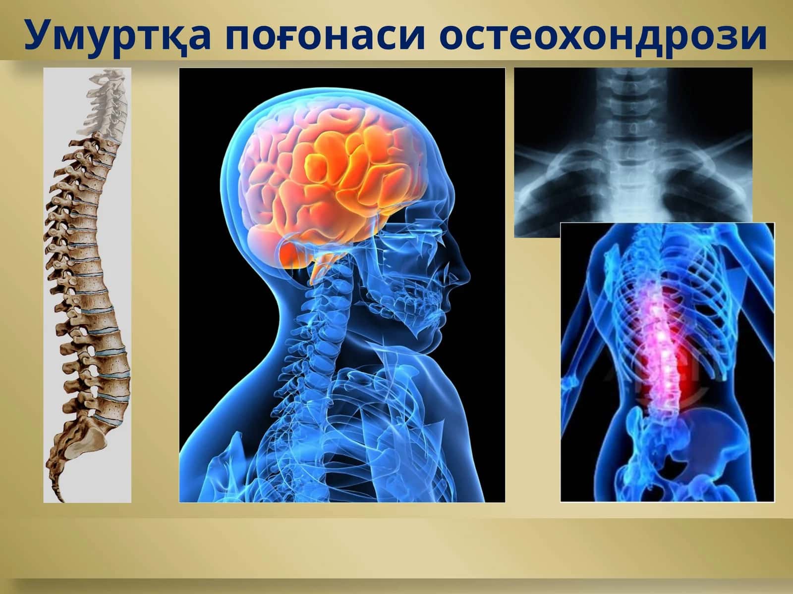 Умуртқа поғонаси остеохондрози