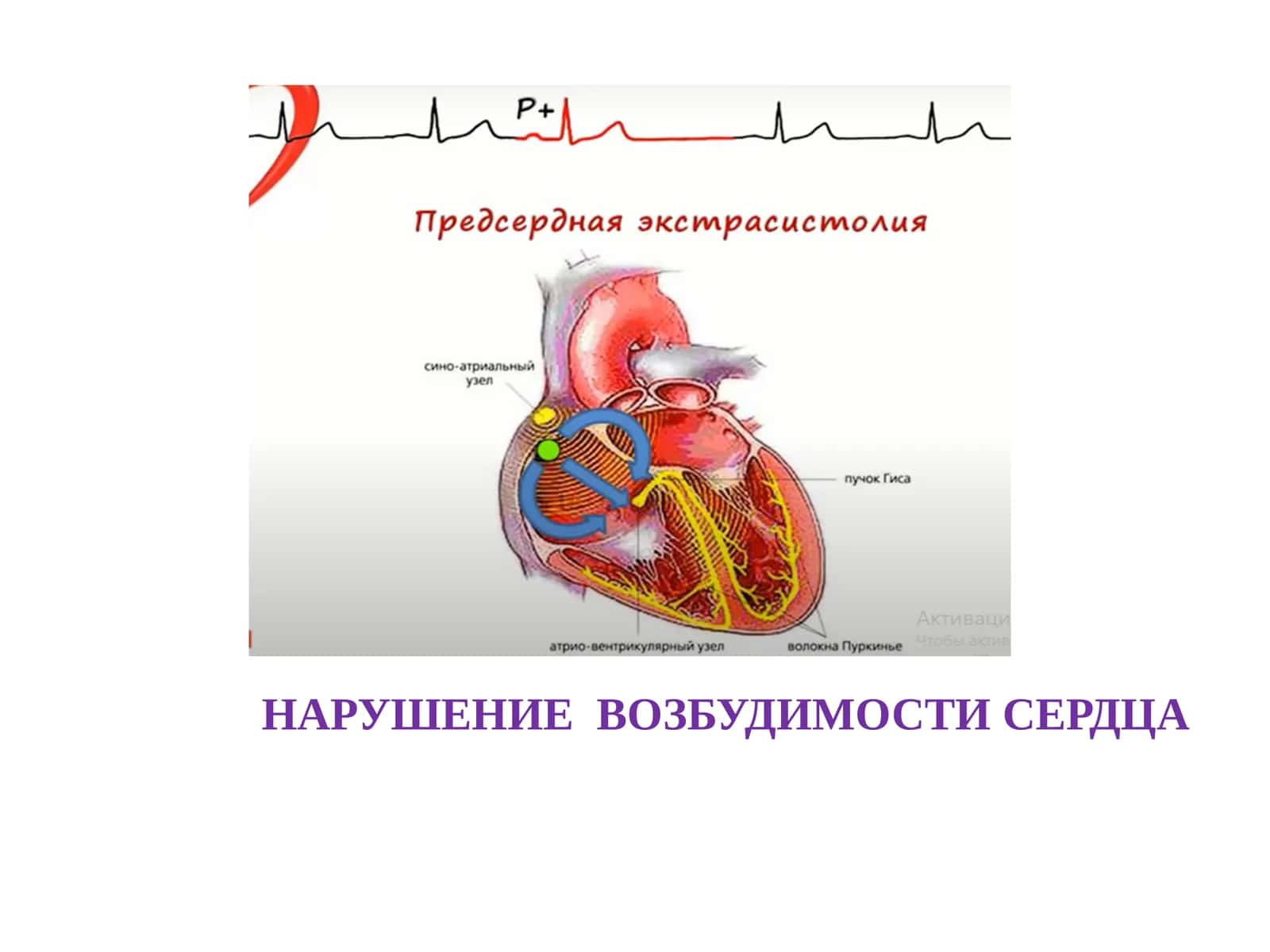 НАРУШЕНИЕ ВОЗБУДИМОСТИ СЕРДЦА