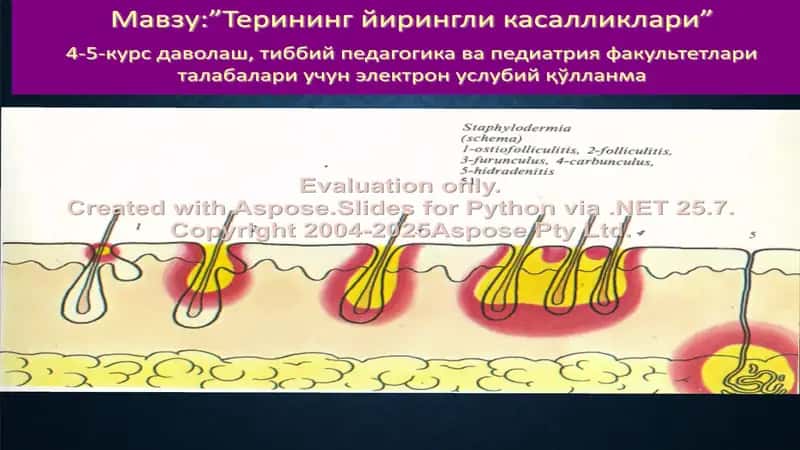 Терининг йирингли касалликлари (Пиодермитлар) электрон услубий қўлланма