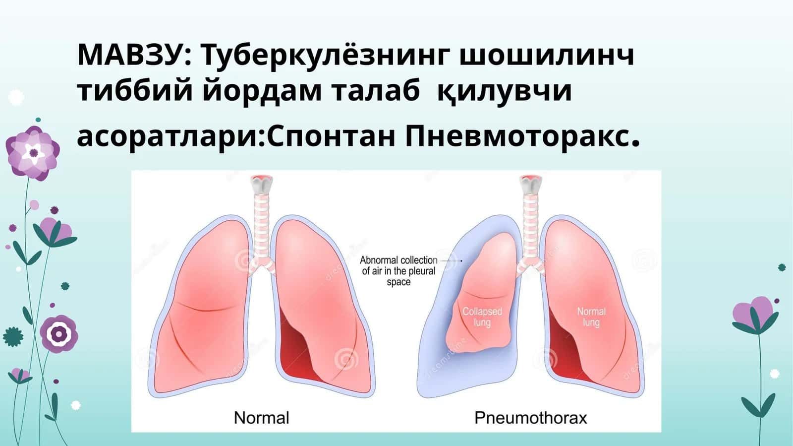 Tuberkulyozning shoshilinch tibbiy yordam talabqiluvchi asoratlari:Spontan Pnevmotoraks