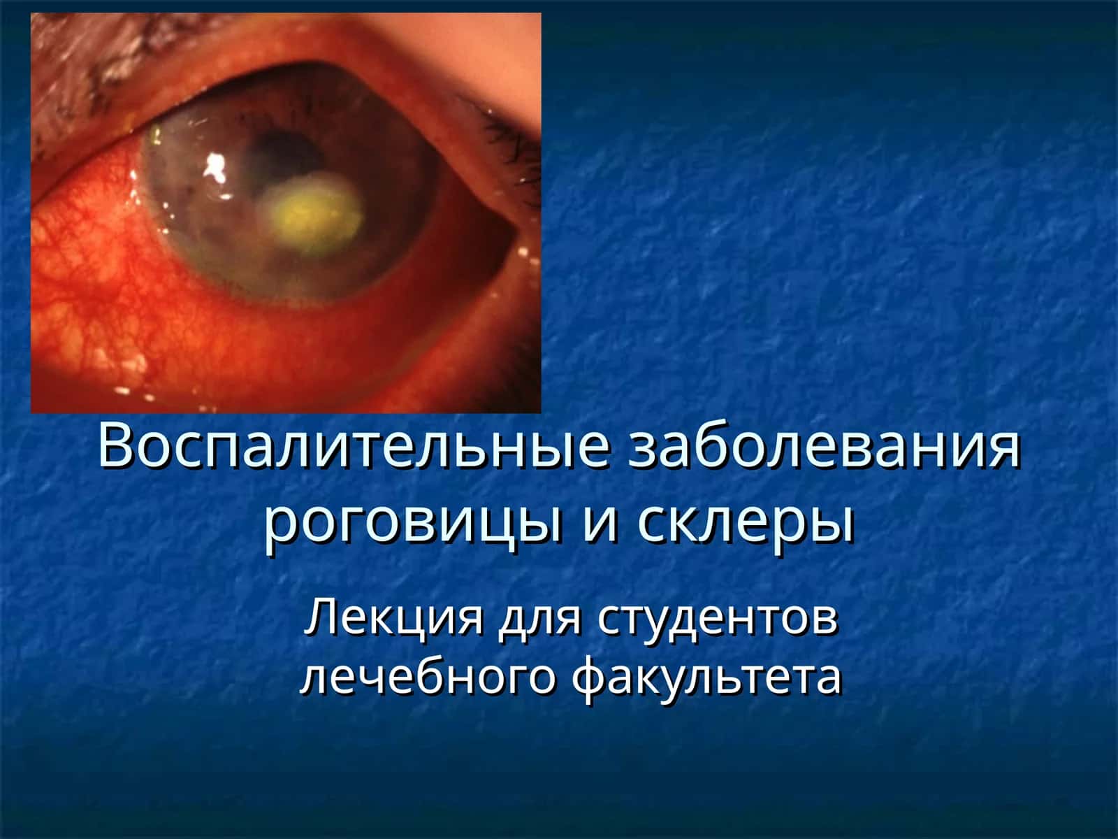 Воспалительные заболевания роговицы и склеры