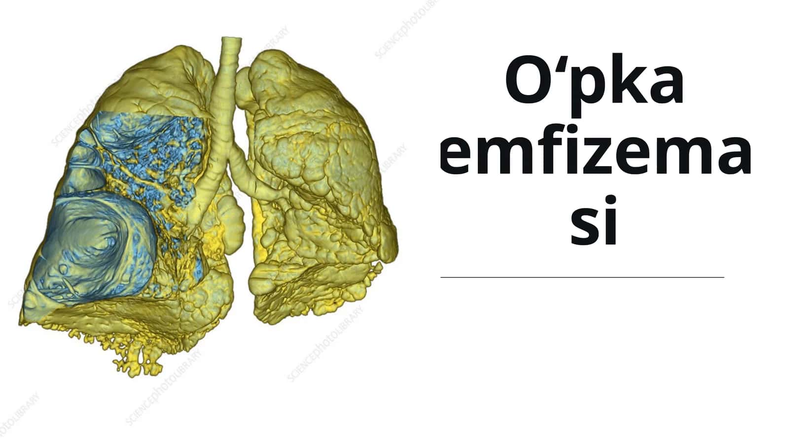 O‘pka emfizemasi