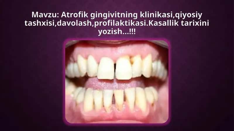 Atrofik gingivitning klinikasi