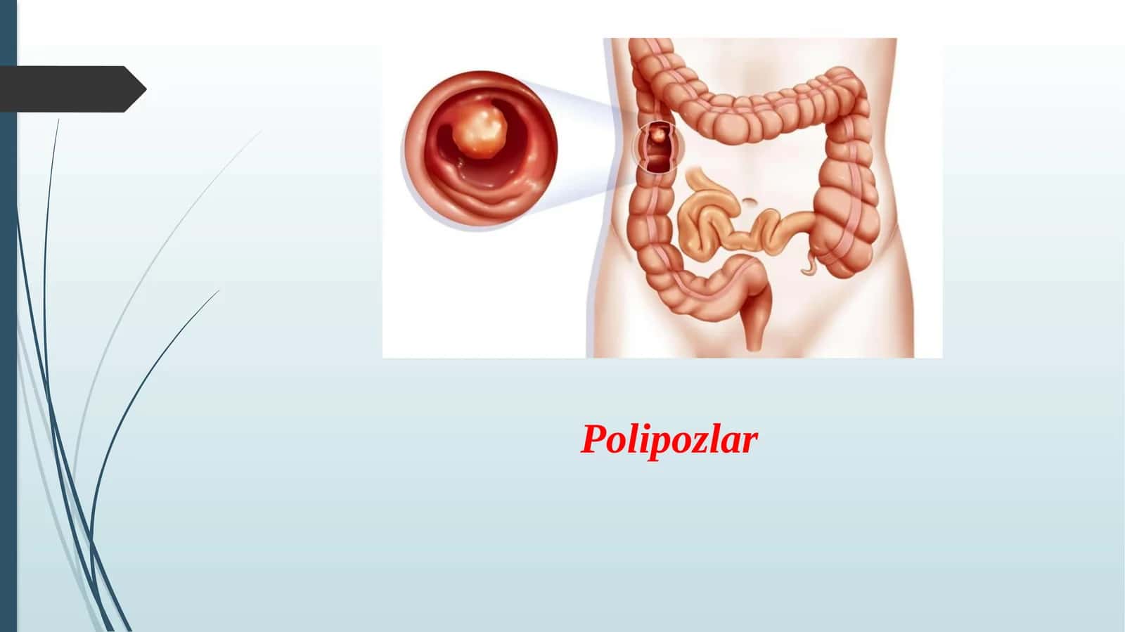 Polipozlar