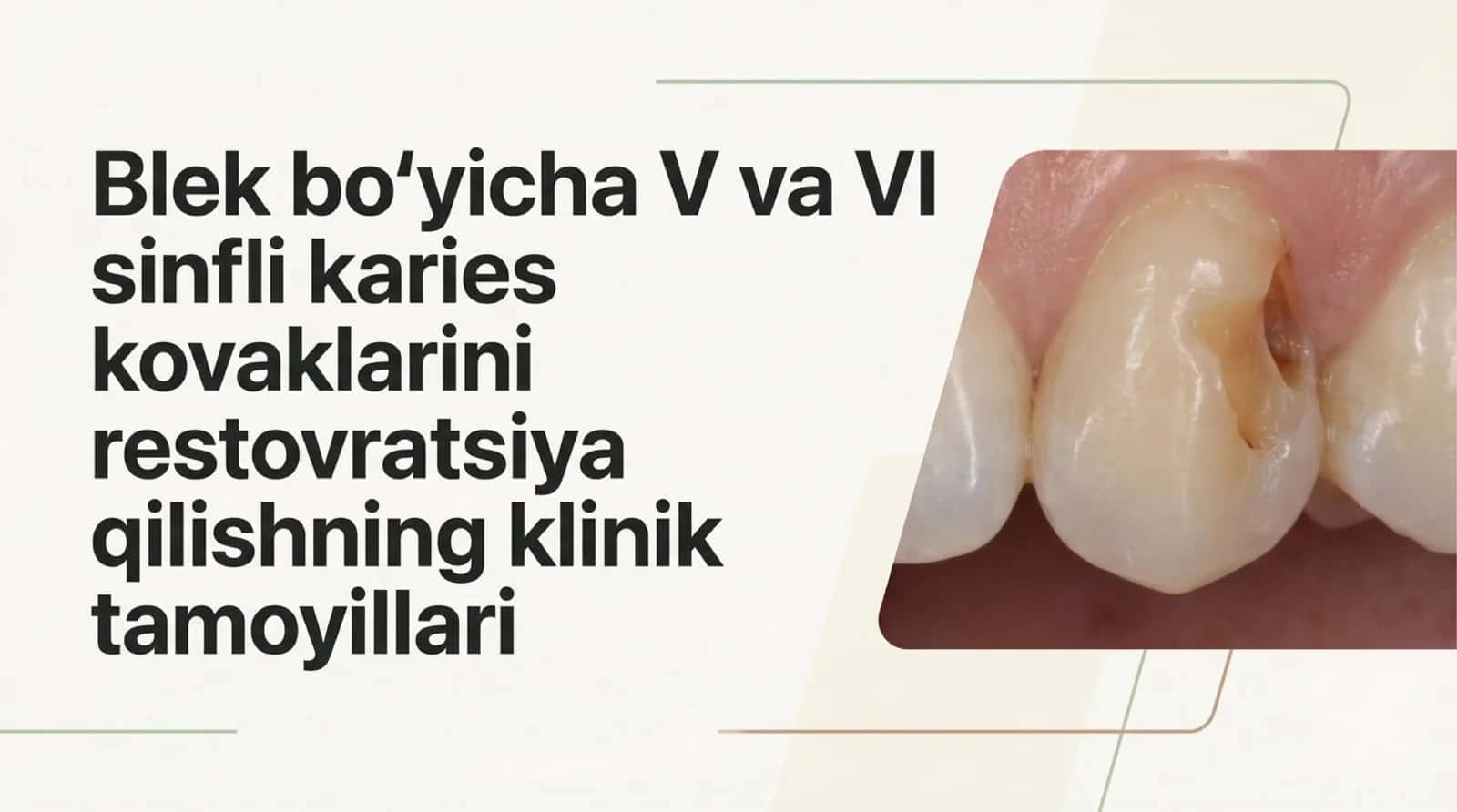 Blek boʻyicha V , VI sinfli karies kovaklarini restovratsiya qilishning klinik tamoyillari