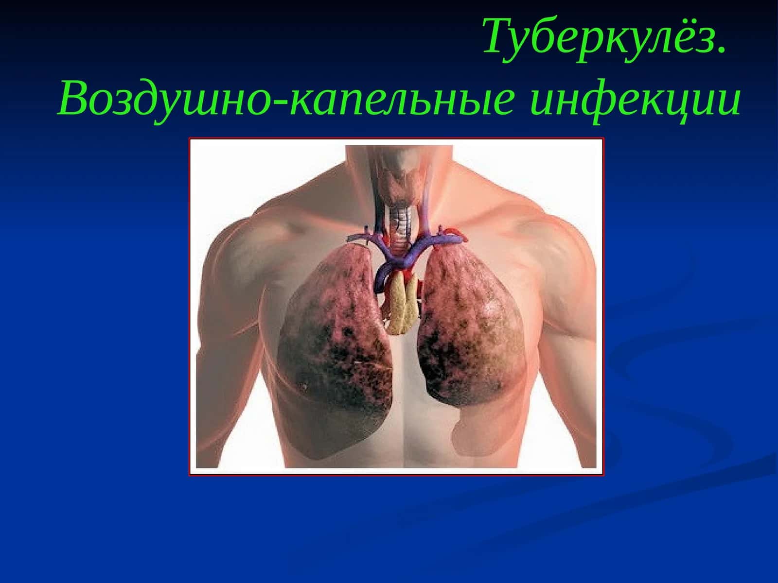 Туберкулёз.Воздушно-капельные инфекции
