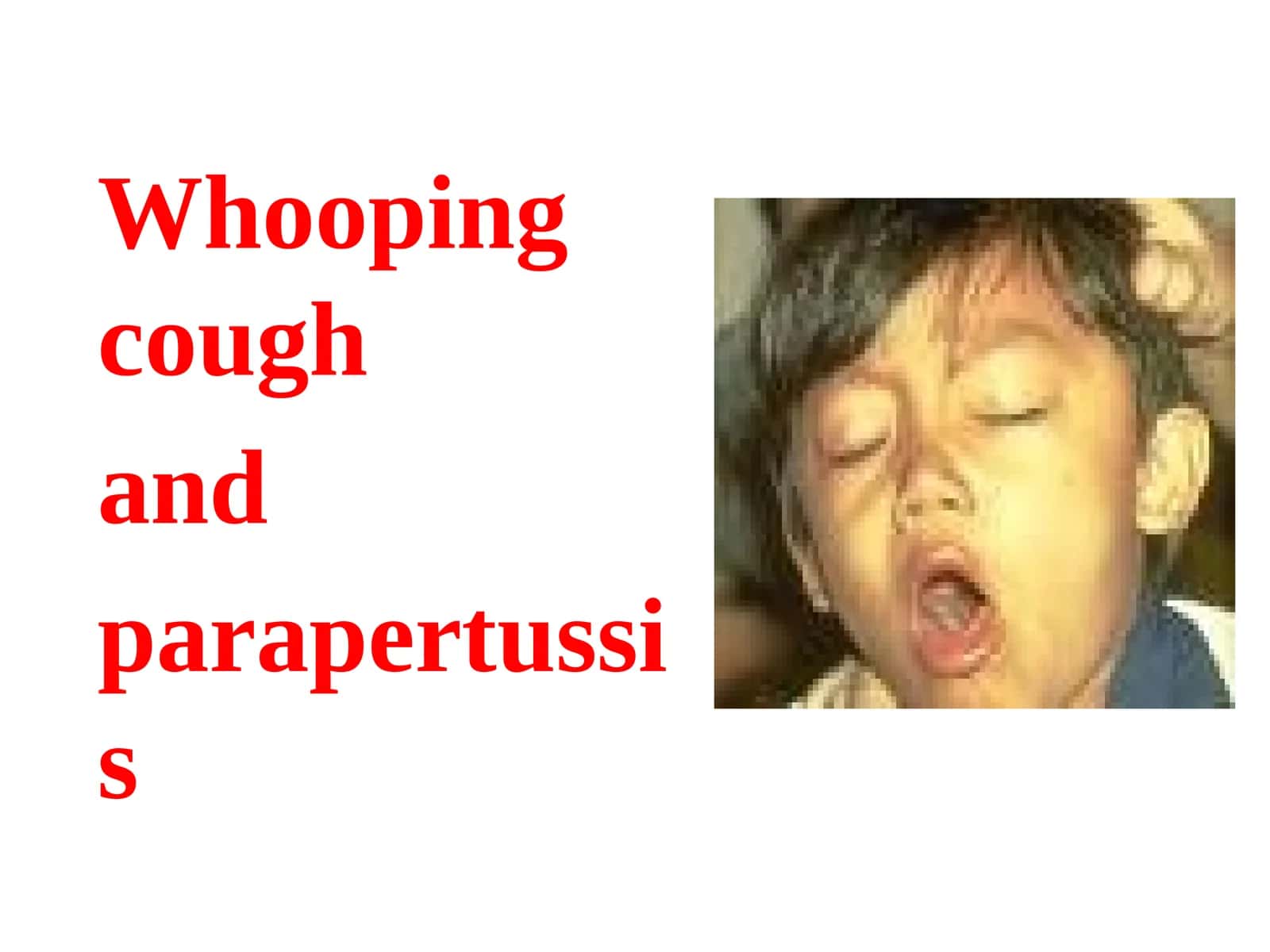 Whooping cough and parapertussis