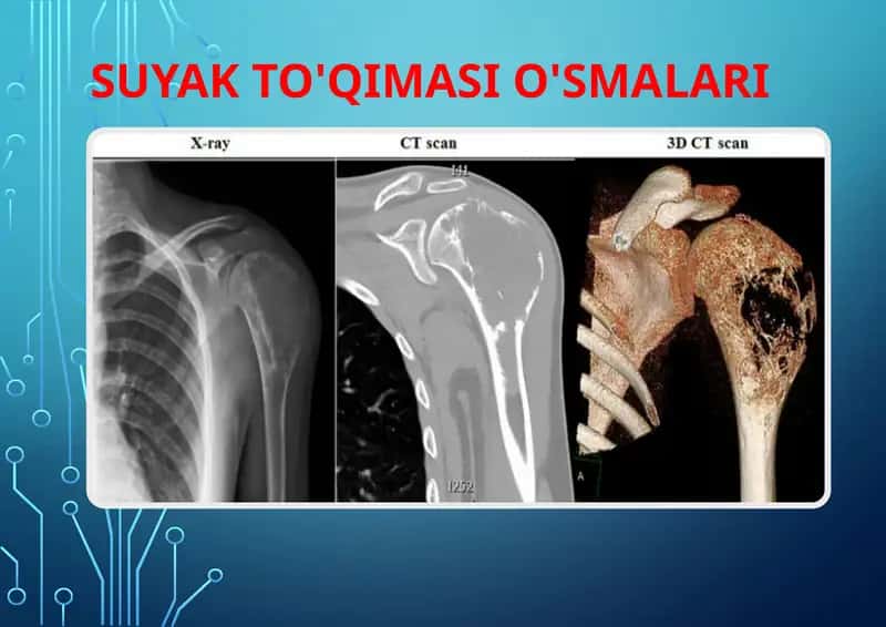 Suyak to'qimasi o'smalari
